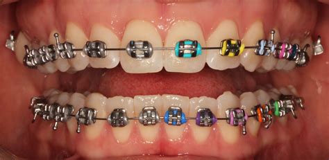 metal brackets orthodontics|stainless steel orthodontic braces.